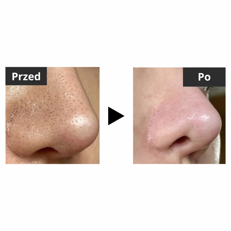 Medicube - One Day Exosome Shot Pore Ampoule 2000 - Rewitalizujące Serum z Mikroigłami - 30ml efekty
